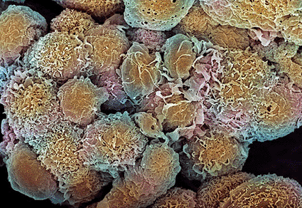 Image: Colored scanning electron micrograph (SEM) of breast cancer cells (Photo courtesy of Steve Gschmeissner / SPL).